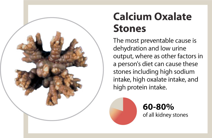 Will Taking Calcium Supplements Cause Kidney Stones At Jacqueline 