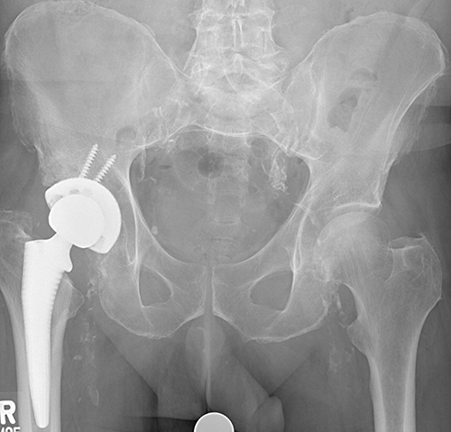 Mixed Reality used to prepare a new hemispherical socket and implant the total hip