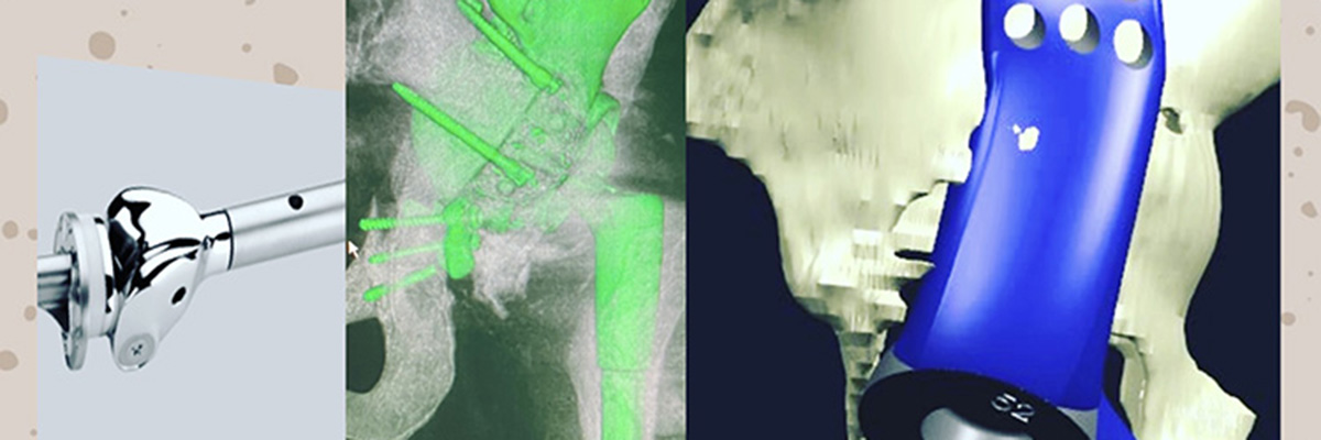  (Left to Right) Modern distal femur replacement, customized design for pelvic reconstruction, and 3D pre-op computerized model plan.