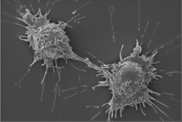 Pictured: Scanning electron micrograph of rare human pheochromocytoma tumor cells.