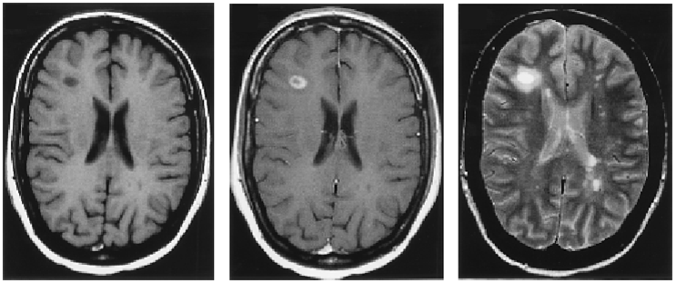 MS MRI Image