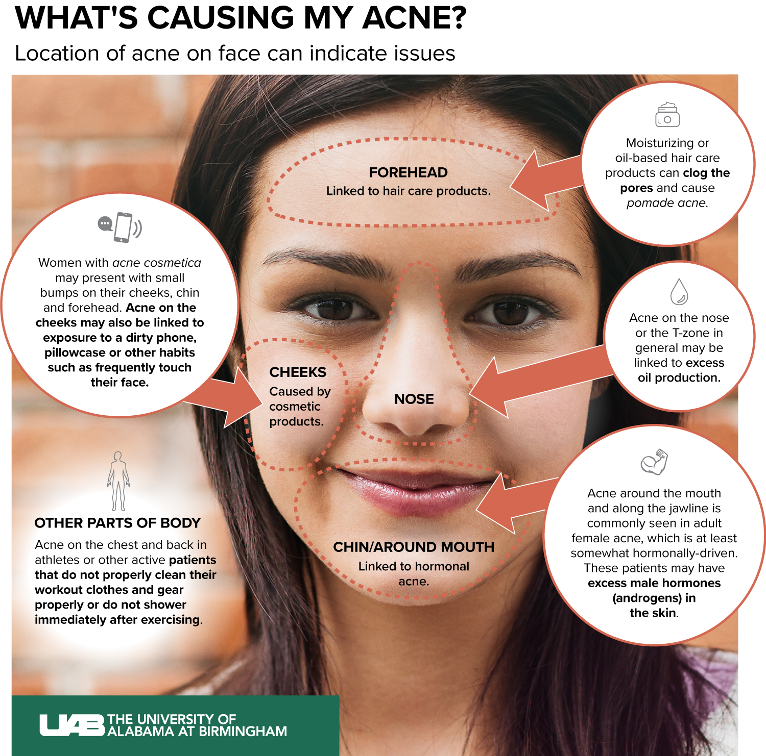 Acne Location On Face Meaning Final 