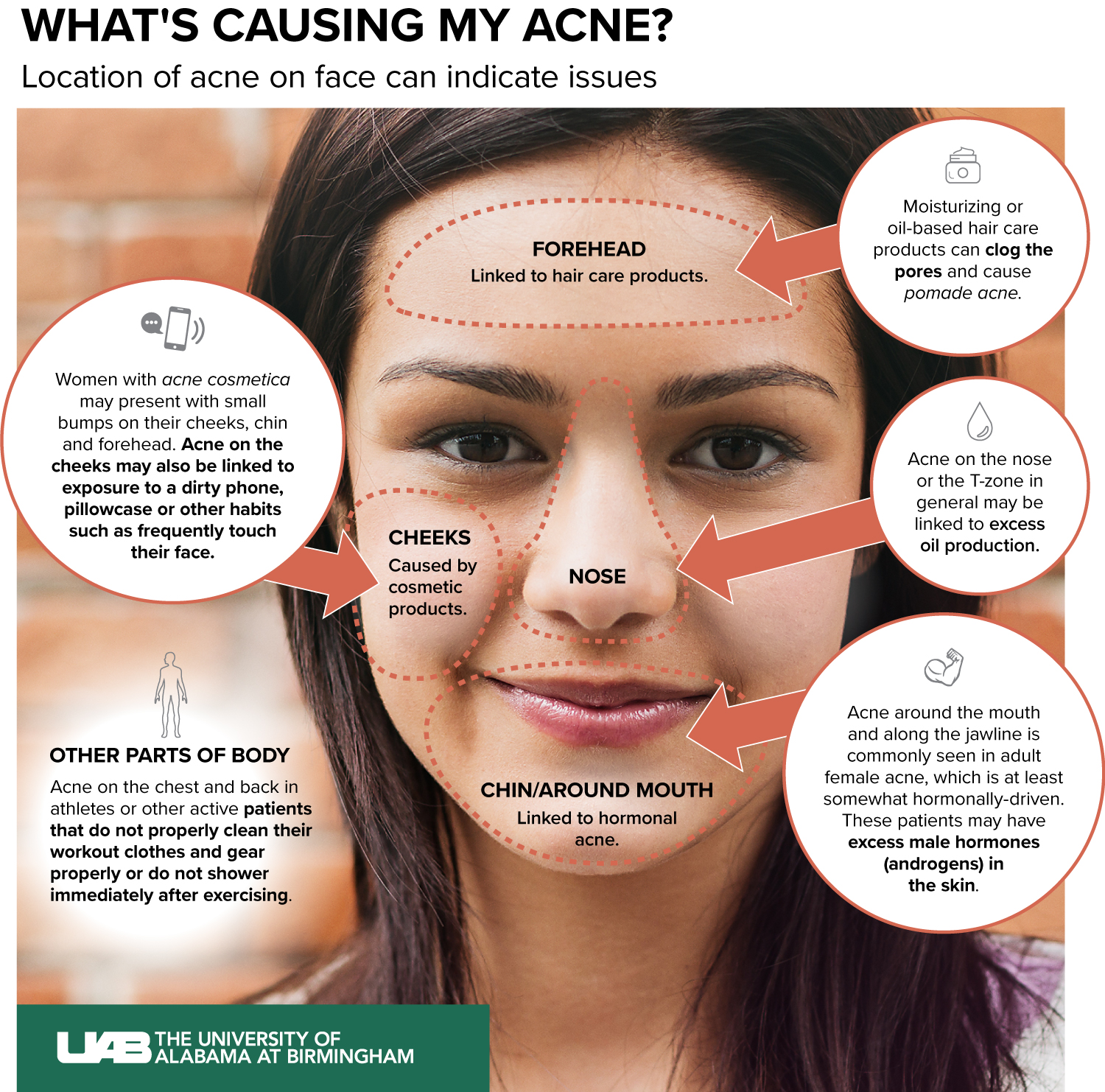 What Is Causing My Acne News UAB