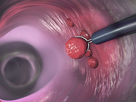 Polyp removal, illustration. Removal of a colonic polyp with an electrical wire loop during a colonoscopy.