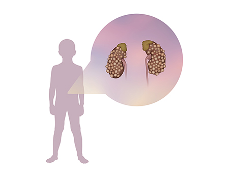 Polycystic kidney in childhood, illustration.