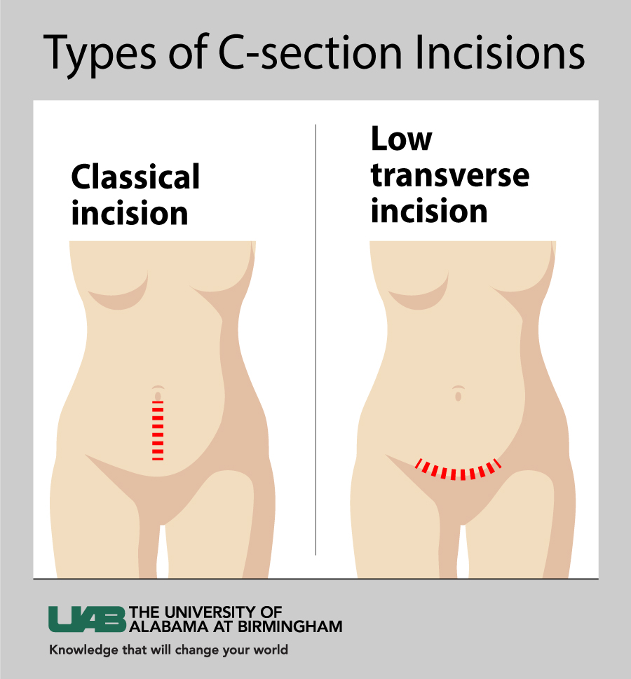 Transverse incision C Section graphic