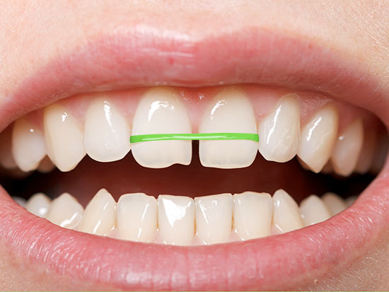 bands in teeth