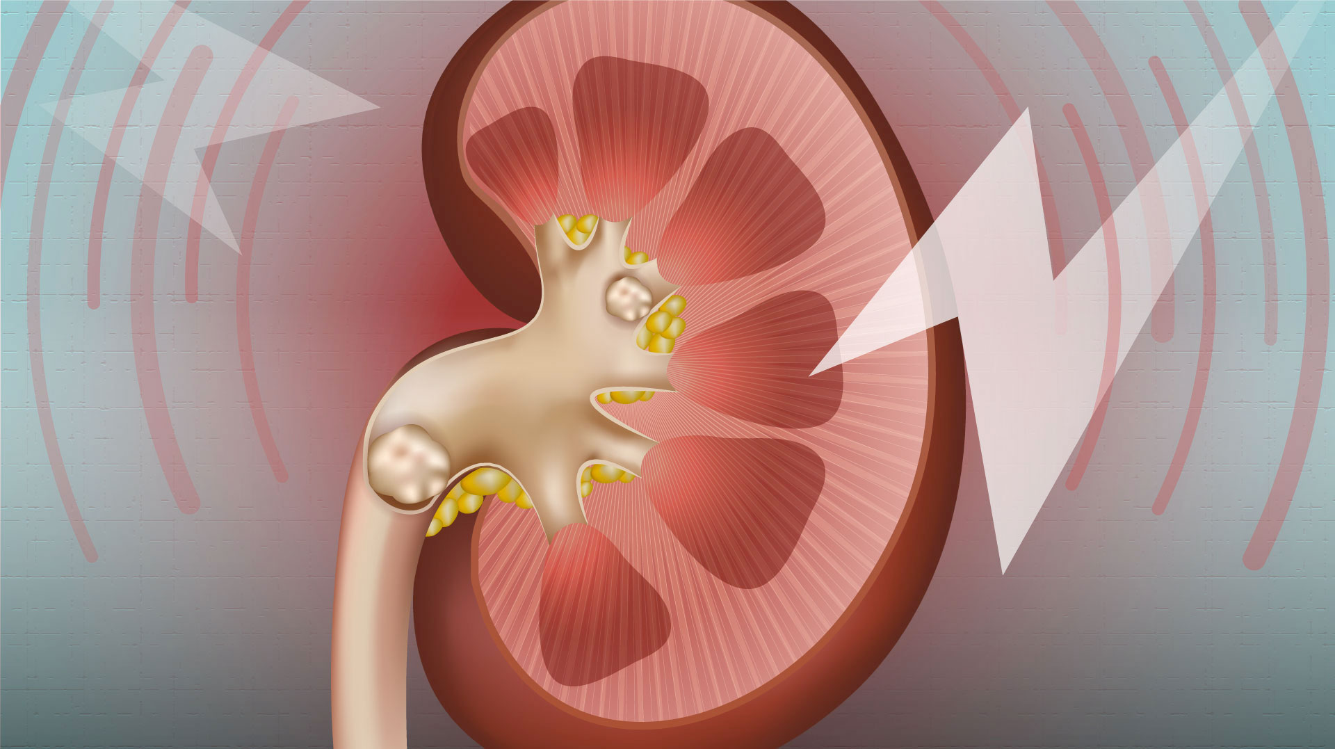 Kidney Stones A Marker Of Overall Kidney Health News UAB