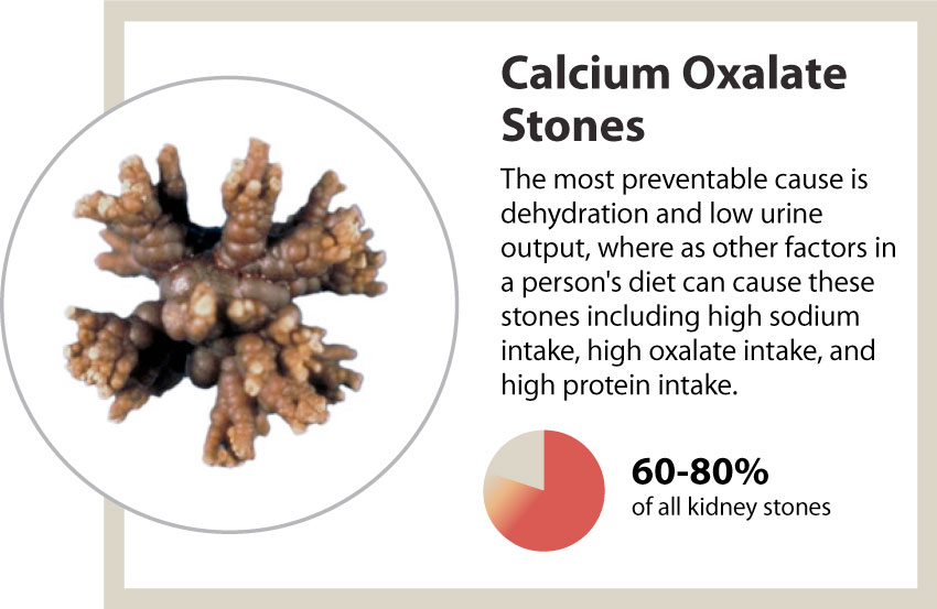 calcium phosphate stones