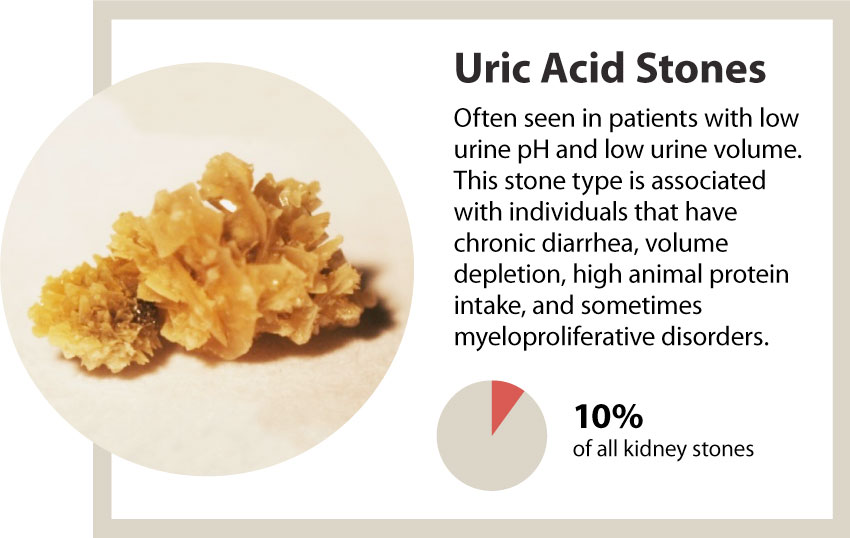 uric acid kidney stones