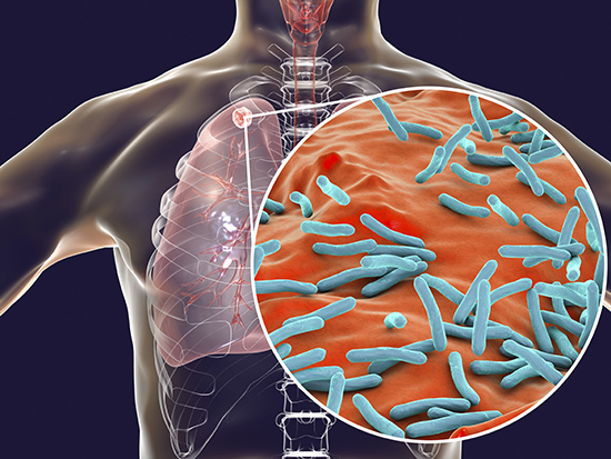 Secondary tuberculosis infection and close-up view of Mycobacterium tuberculosis bacteria, the causative agent of tuberculosis. Computer illustration showing small-sized solid nodular mass located in the upper lobe of right lung near lung apex.