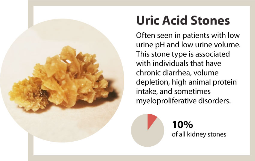 Kidney stones - a marker of overall kidney health - UAB News