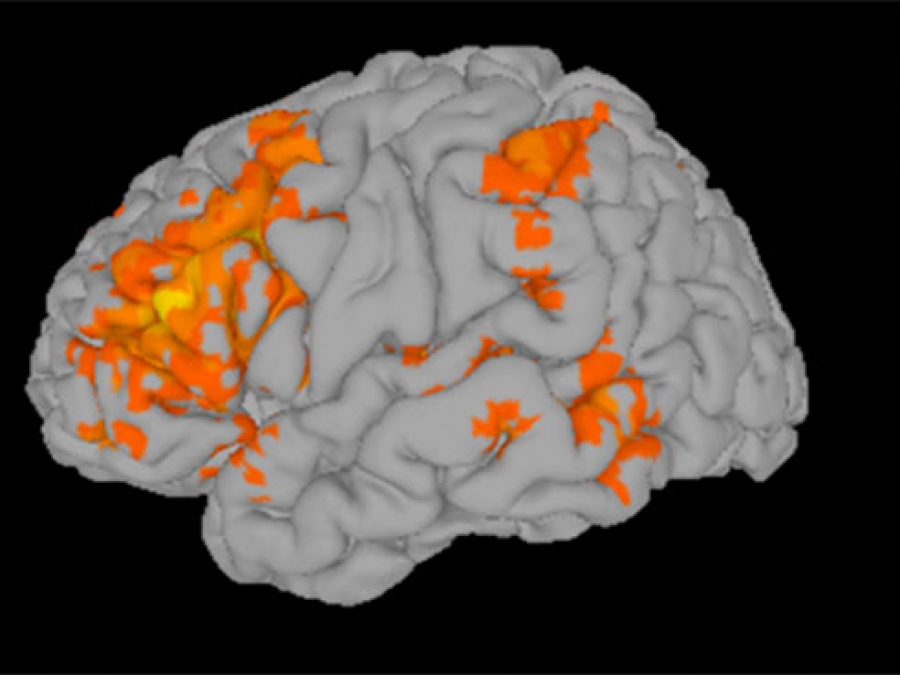 autistic-children-improved-reading-and-brain-activity-after-10-week