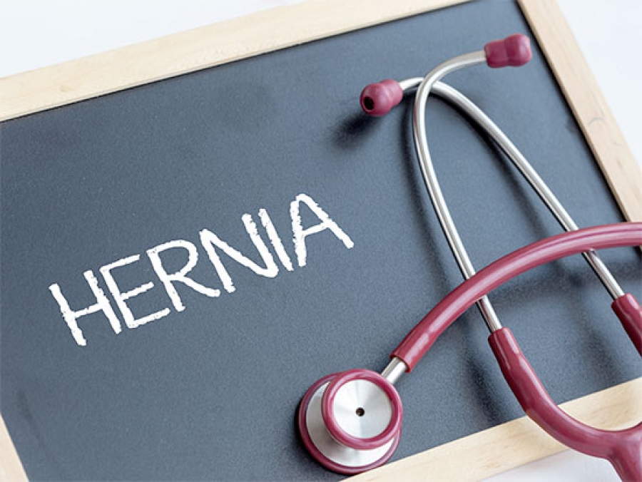 Hernias: why they hurt and what can be done - News | UAB