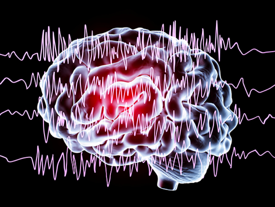 uab-developed-algorithm-may-predict-the-onset-of-seizure-clusters