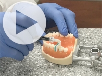 New cavity treatment offers no drilling, no filling