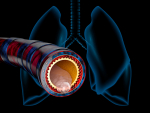 Reduced sialylation of mucin impairs mucus transport in lungs