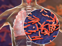 NIH grant establishes UAB’s Global Research Resource for Human Tuberculosis